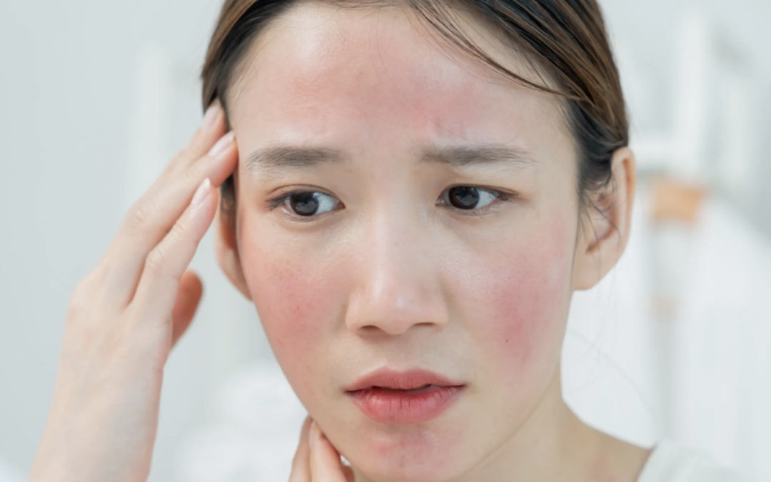 Rosacea Redness Relief With a IPL Photofacial Near Potomac, MD